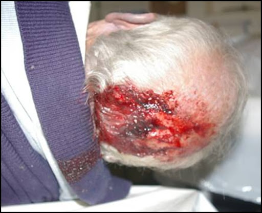 AlzheimersuffererJamesBrown12