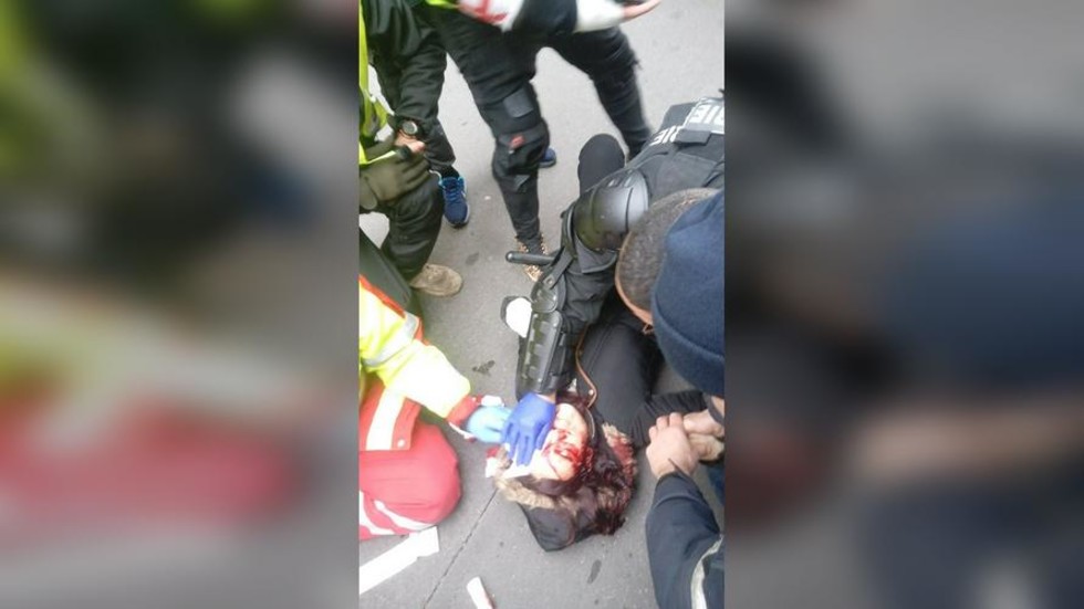 Yellow Vests who have lost eyes, limbs demand justice from Macron 3 5c682a24dda4c804508b4618