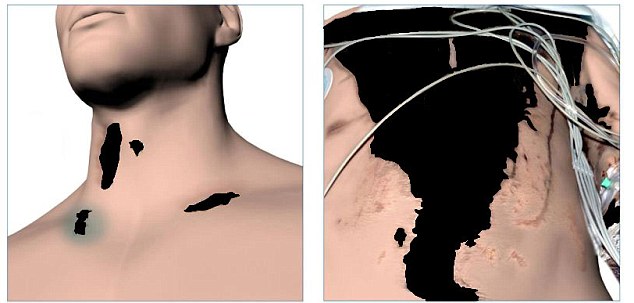 Awais Akram's neck, left, and torso were left badly burned after the attack