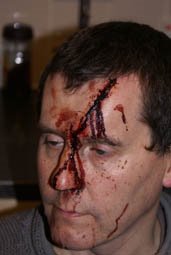 bnp attack