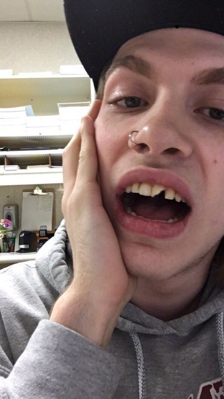 tooth knocked out trump